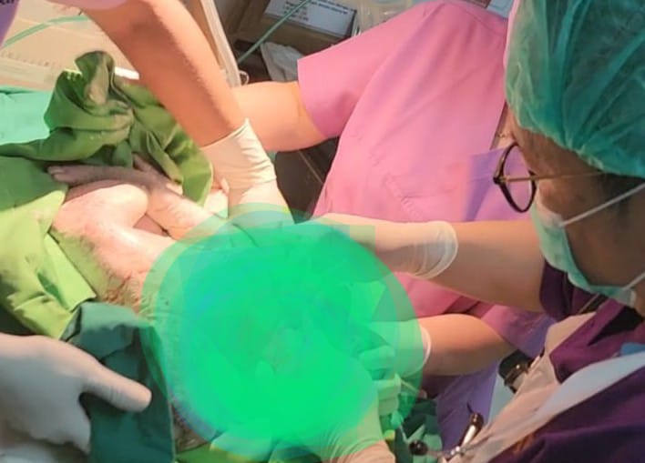 Proses operasi bayi kembar siam yang dilakukan enam dokter di RSUD Jayapura, Jumat (24/1/2025). (CEPOSONLINE.COM/Dok RSUD Jayapura).