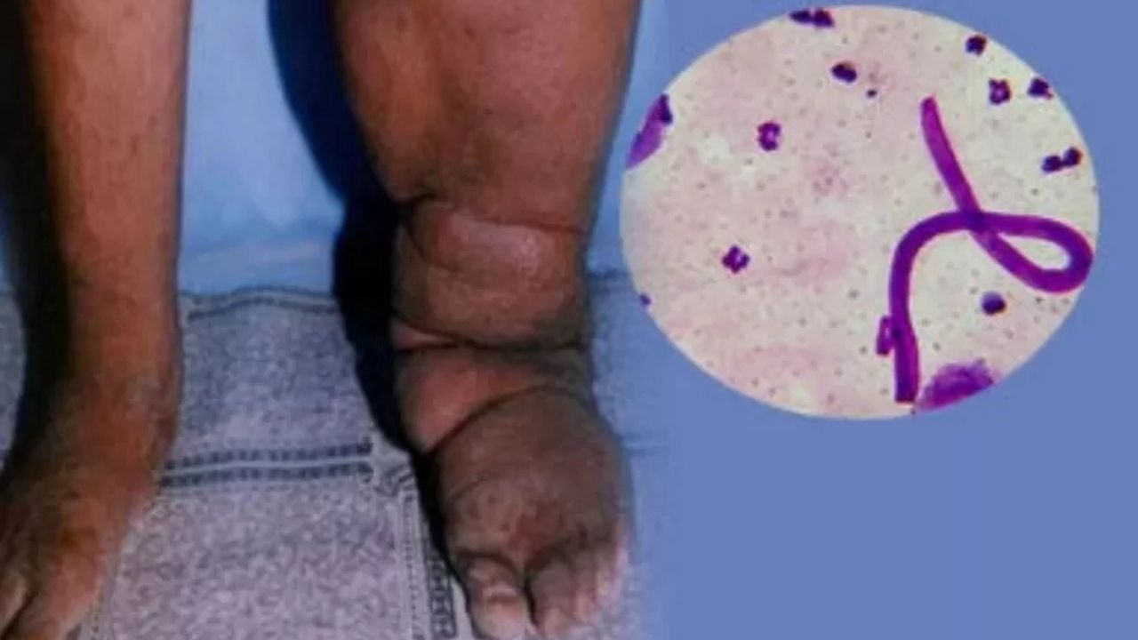 Filariasis (Dok. Freepik)