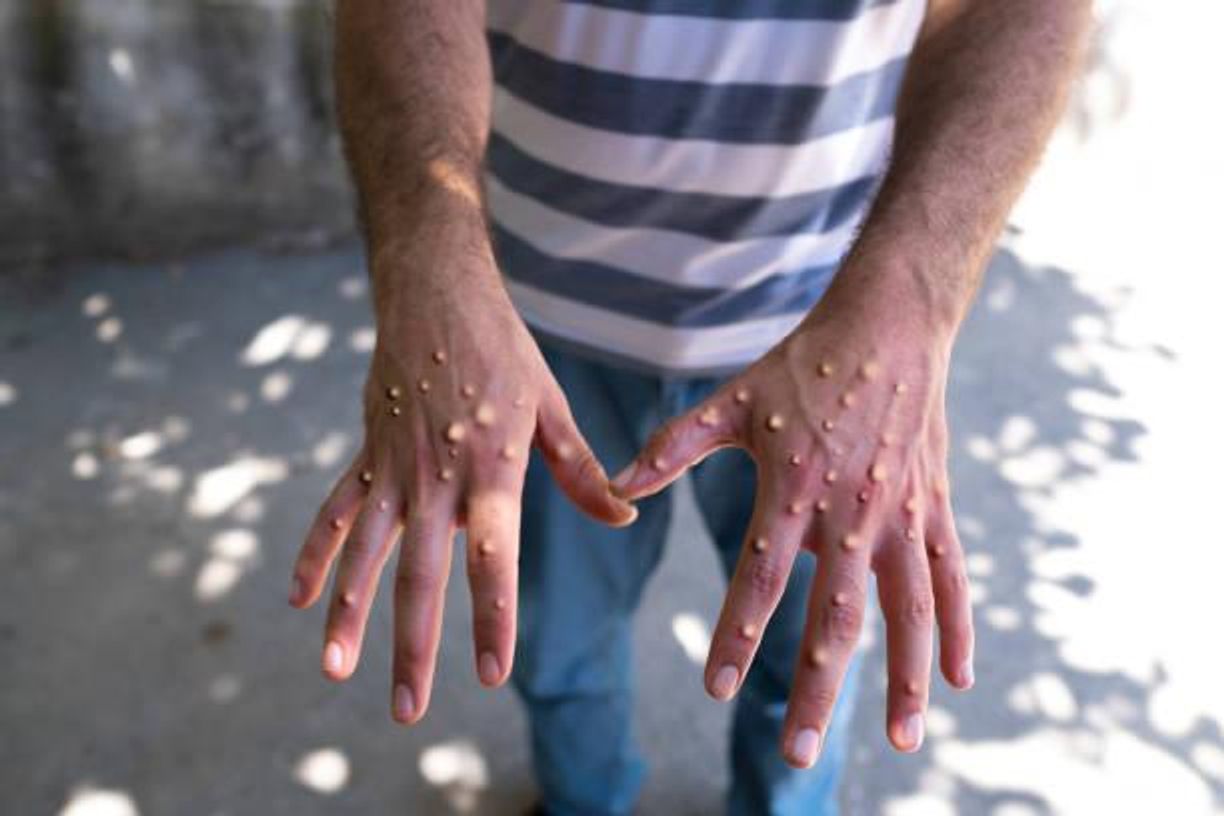 Ilustrasi cacar monyet atau monkeypox.(Foto:iStock)
