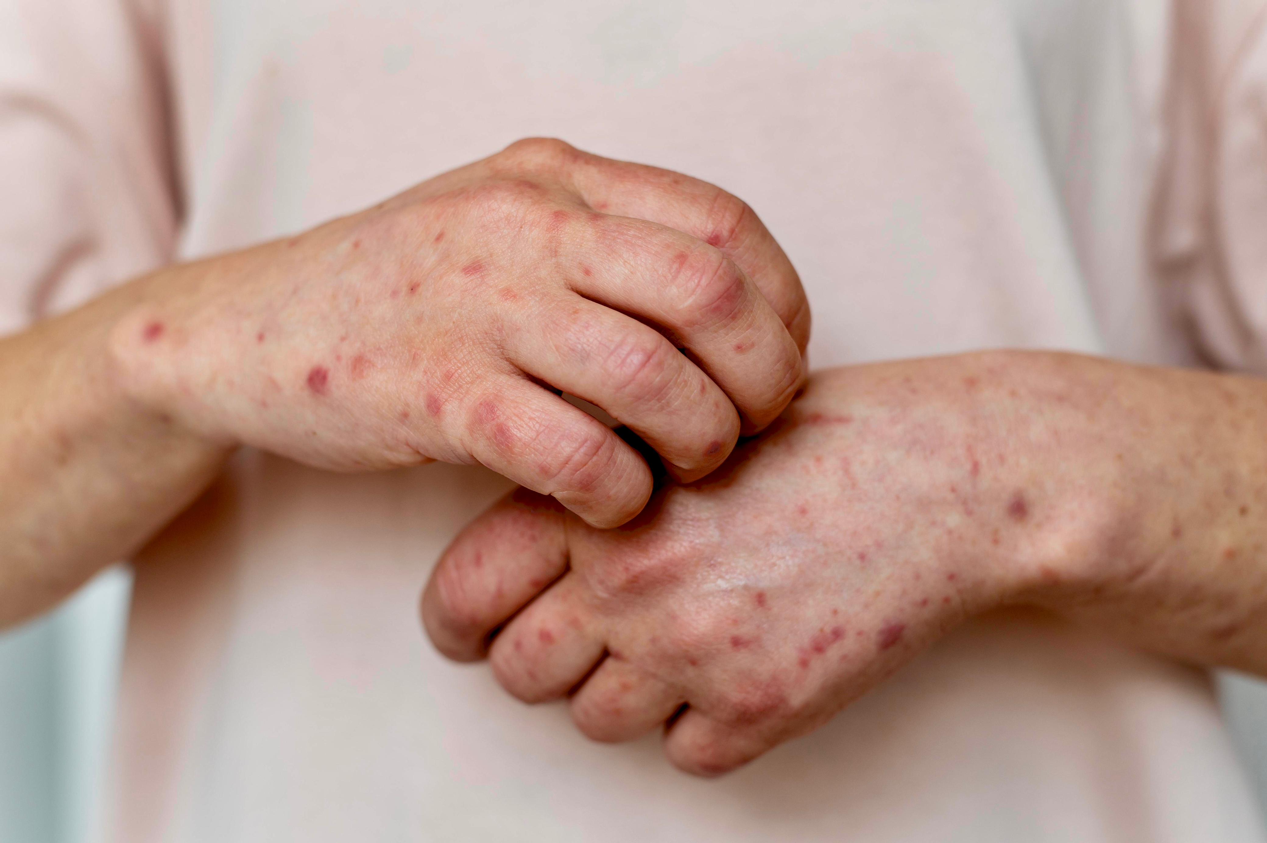 ILUSTRASI RUAM CACAR: Pengidap monkeypox ditandai dengan ruam kulit dan berbintil nanah. (Sumber: Freepik)