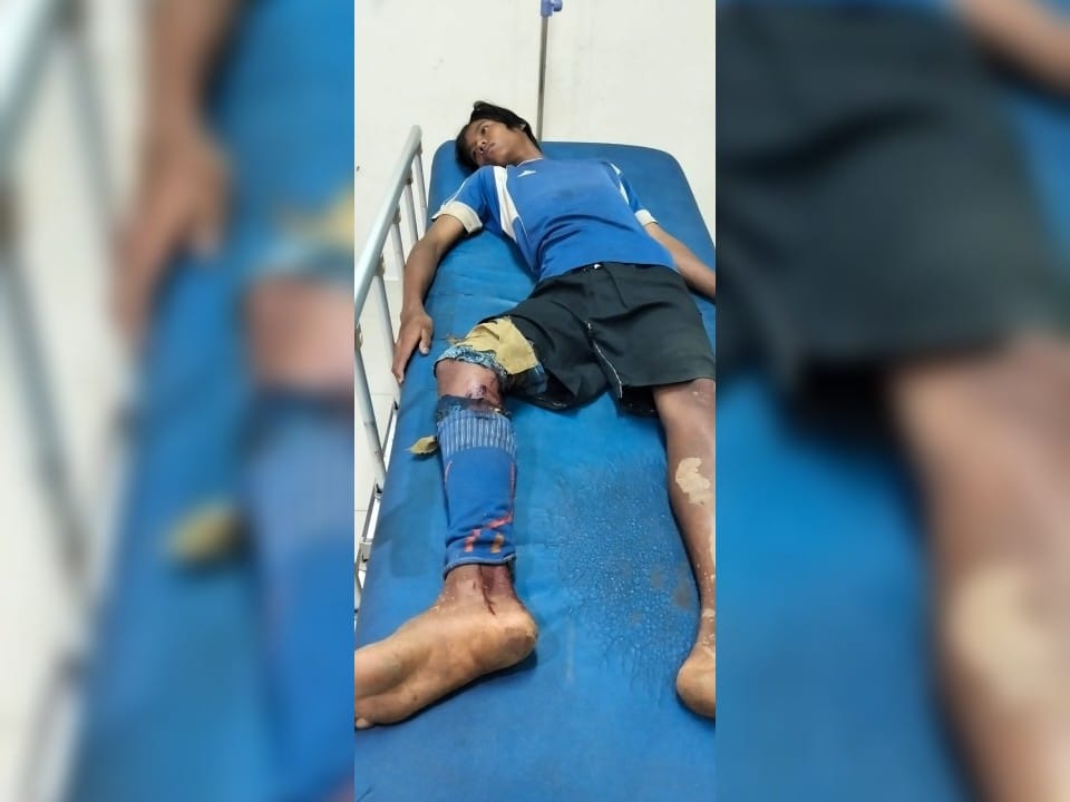 DIRAWAT: Surya, warga Kandangan Lama, Kecamatan Panyipatan yang diserang buaya saat memancing pada Jumat (12/12/2025).