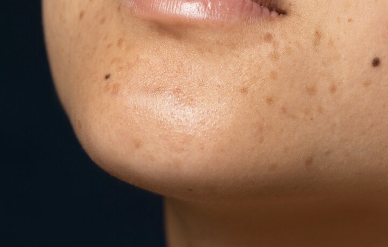 DARK SPOT: Flek hitam tak selalu muncul karena efek penuaan, saat muda sekalipun juga bisa. (Foto: Freepik)