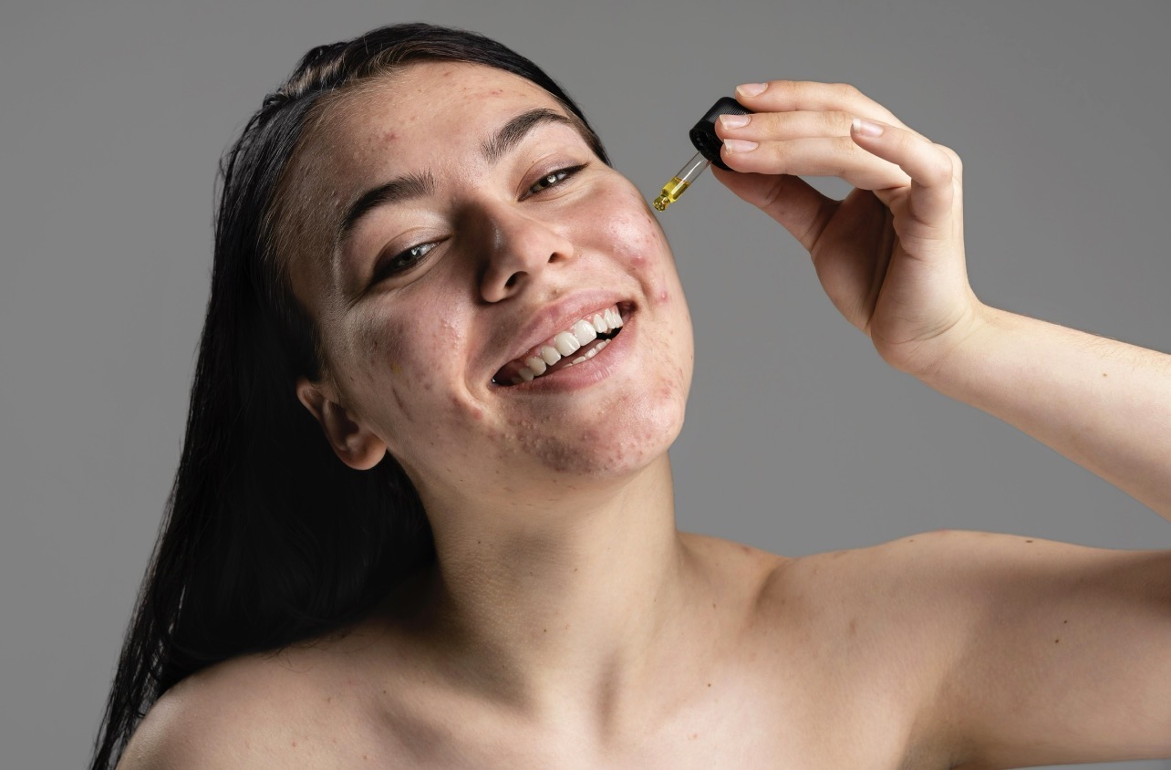 HATI-HATI: Tak semua skincare boleh diaplikasikan pada kulit berjerawat aktif. (Foto: Freepik)