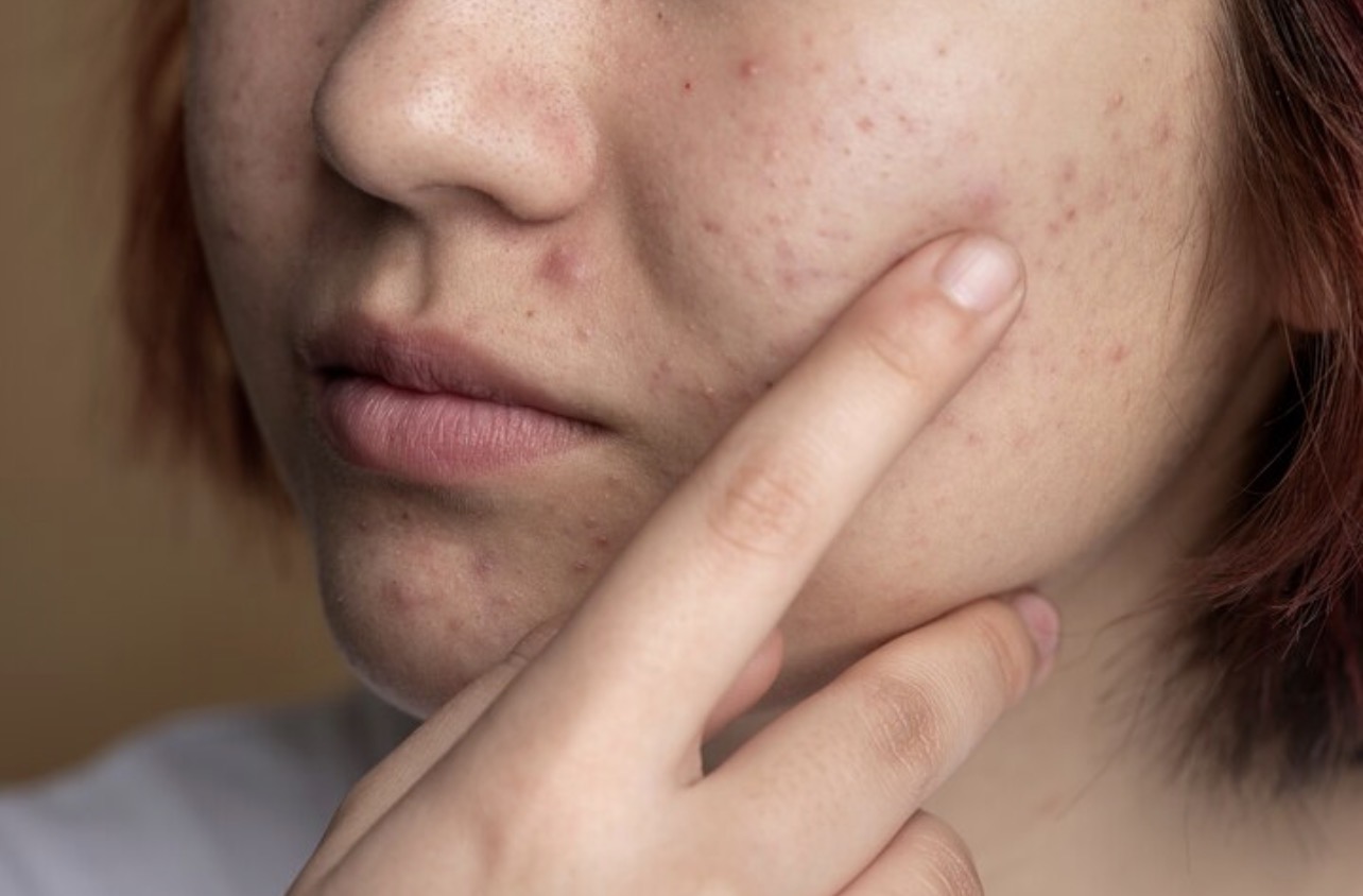 HORMON: Jerawat hormonal dan jerawat biasa memiliki karakteristik yang berbeda. (Foto: Freepik)