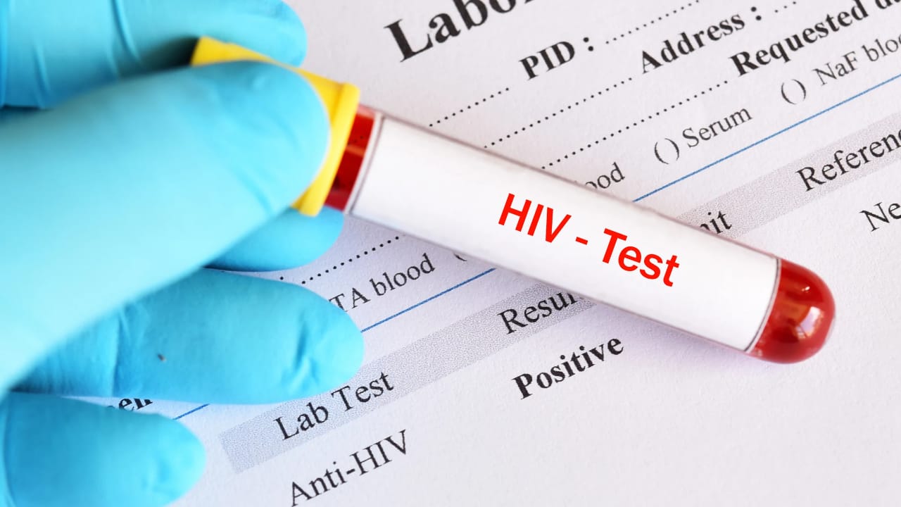 ILUSTRASI: Tes Penyakit Human Immunodeficiency Virus (HIV).