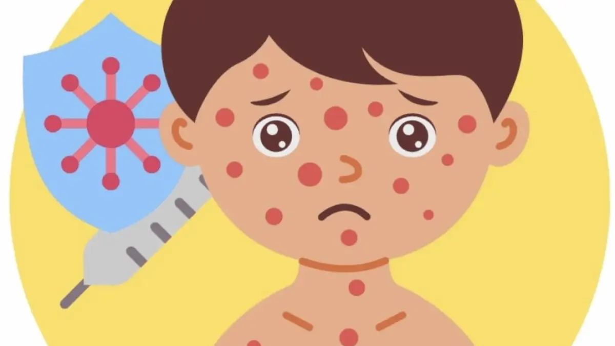 ILUSTRASI: Penyakit campak menyerang anak-anak. 