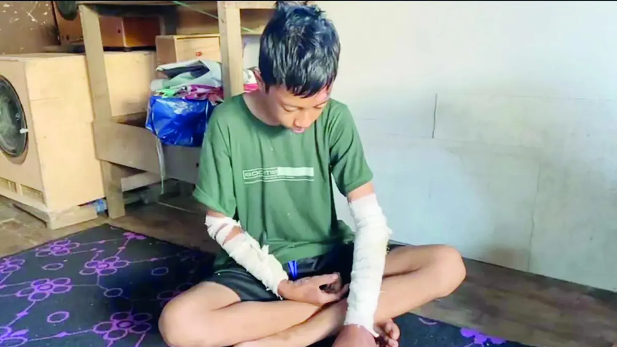 TERLUKA: M. Fahriza menderita luka bakar saat berhadapan dengan karhutla pada Jumat (21/8) sore.&nbsp;
(Foto: SHEILLA FARAZELA/RADAR BANJARMASIN)&nbsp;