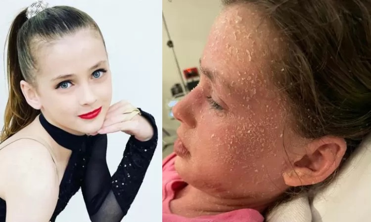 Kondisi Summah sebelum (kiri) dan sesudah (kanan) didiagnosis menderita eksim ekstrem, serta alergi terhadap air mata dan keringatnya.