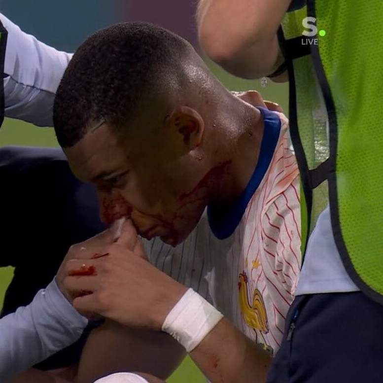 Tulang hidung Mbappe patah.