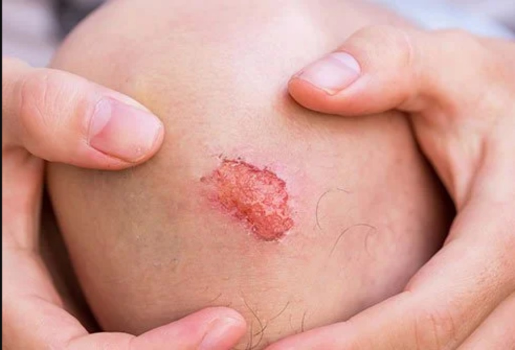 ilustrasi luka dekubitus