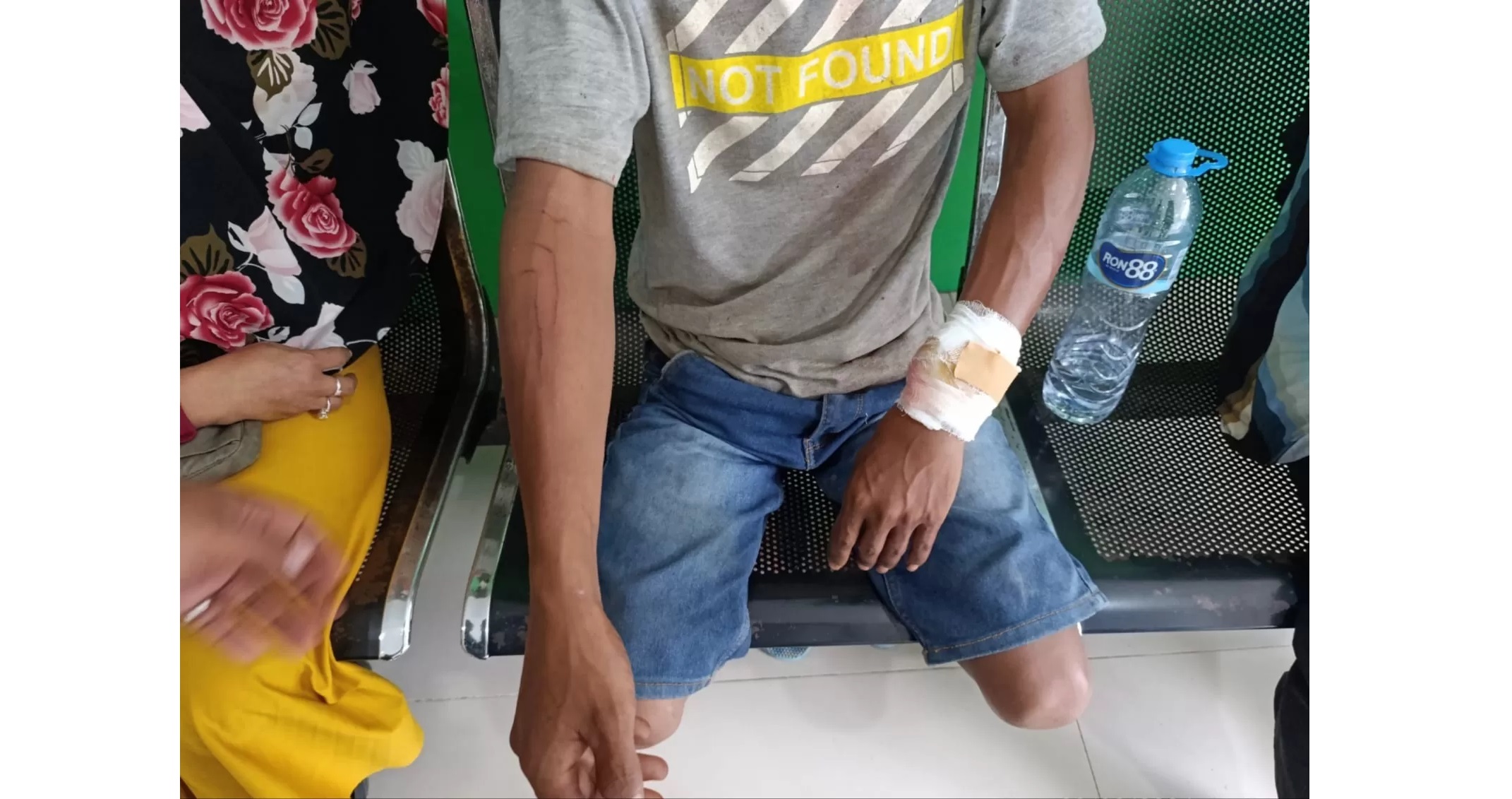 LUKA-LUKA: Hasan menunjukkan luka-luka di tangannya akibat gigitan buaya.