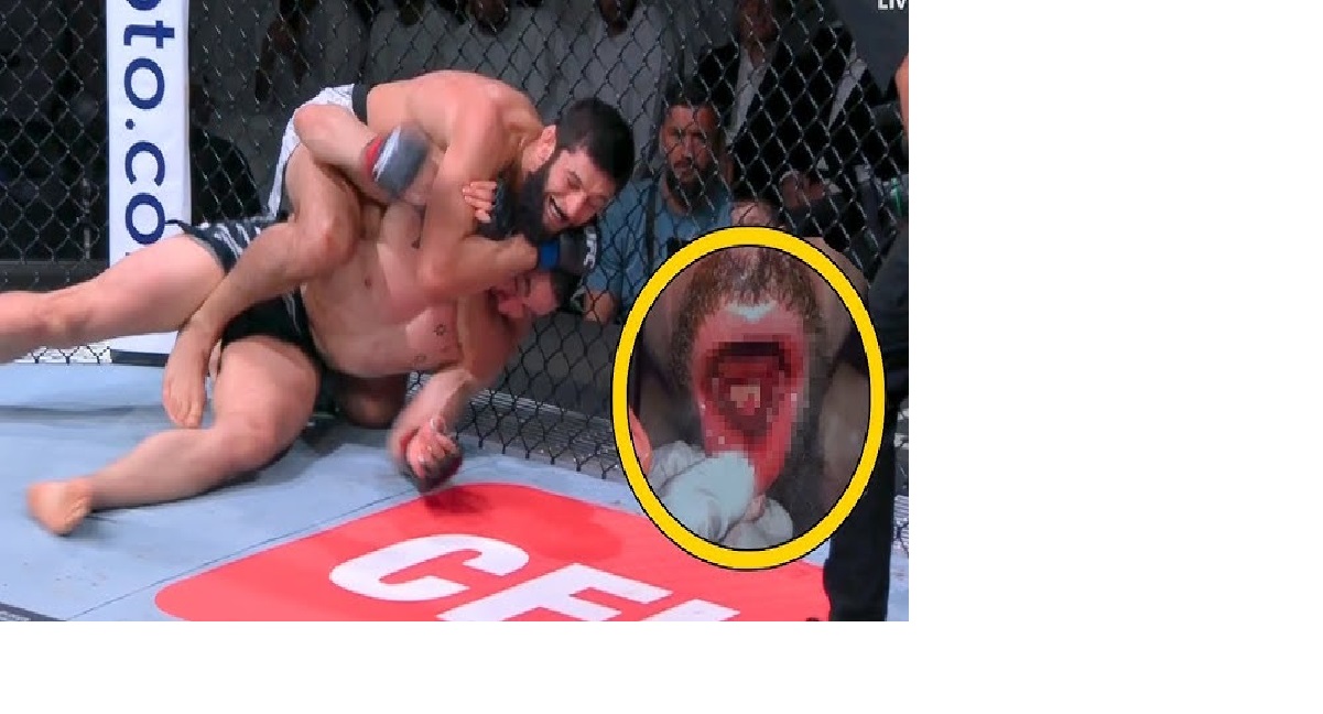 Detik-detik Chimaev akan mencekik Whittaker. Tampak kerusakan pada gigi dan rahang Whittaker.