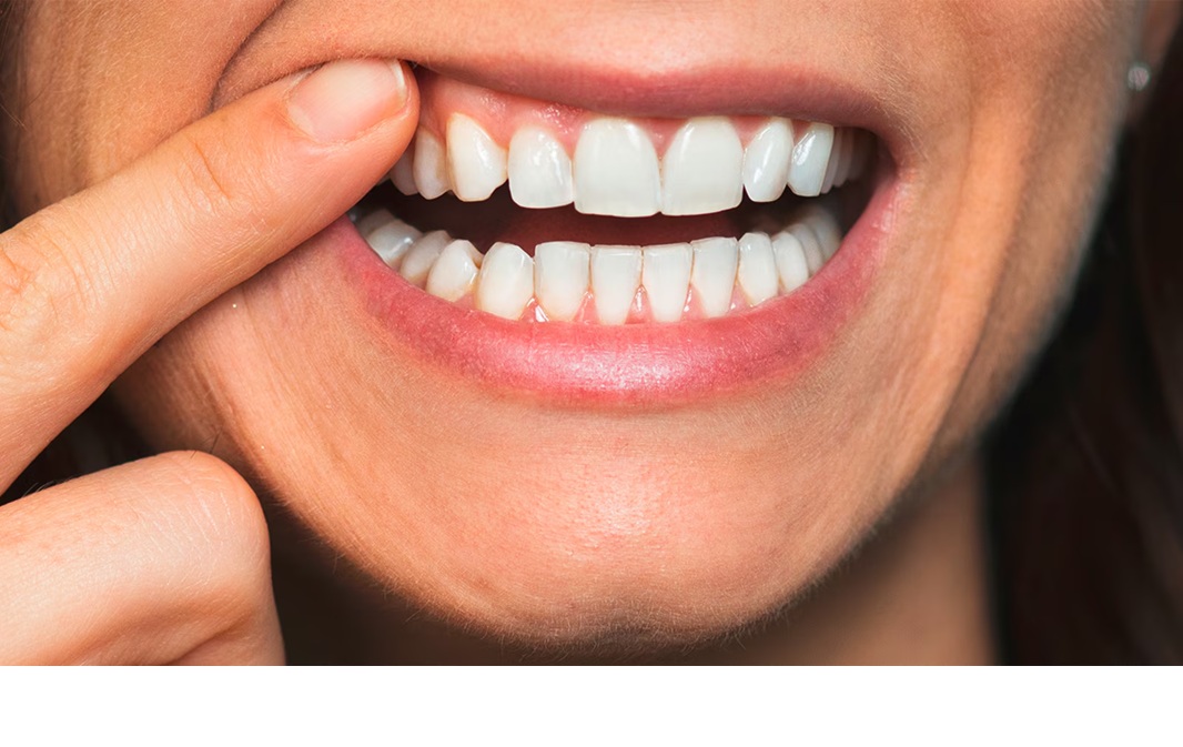 Ilustrasi gigi sehat.