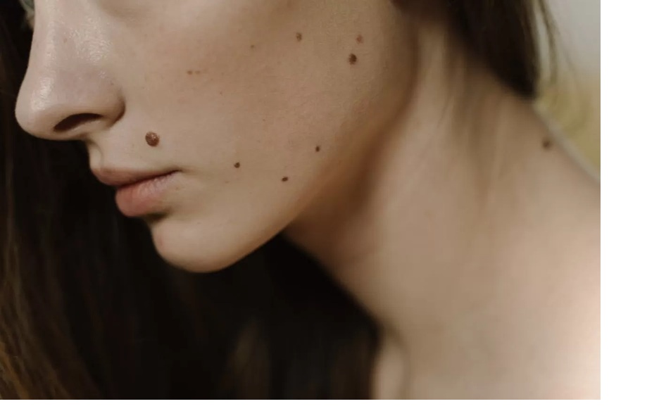 Ilustrasi tahi lalat.