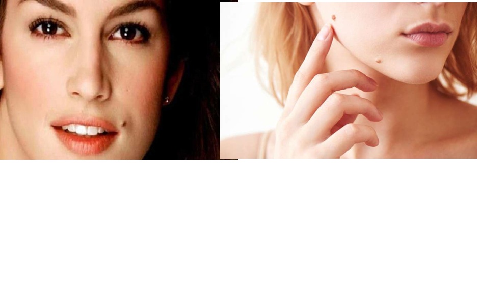 Ilustrasi tahi lalat.