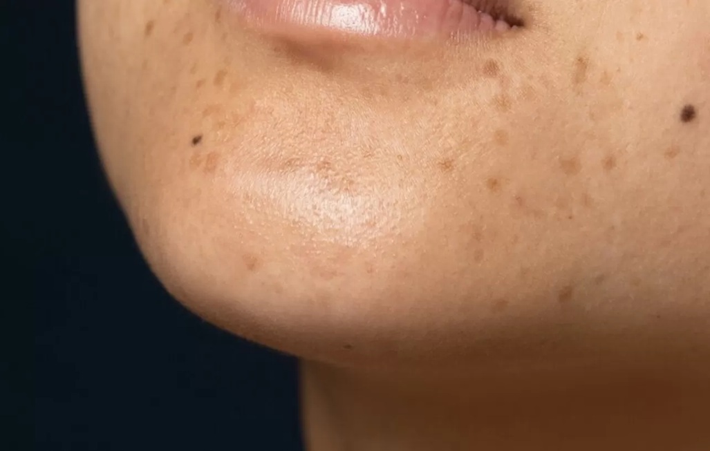 Ilustrasi flek hitam.