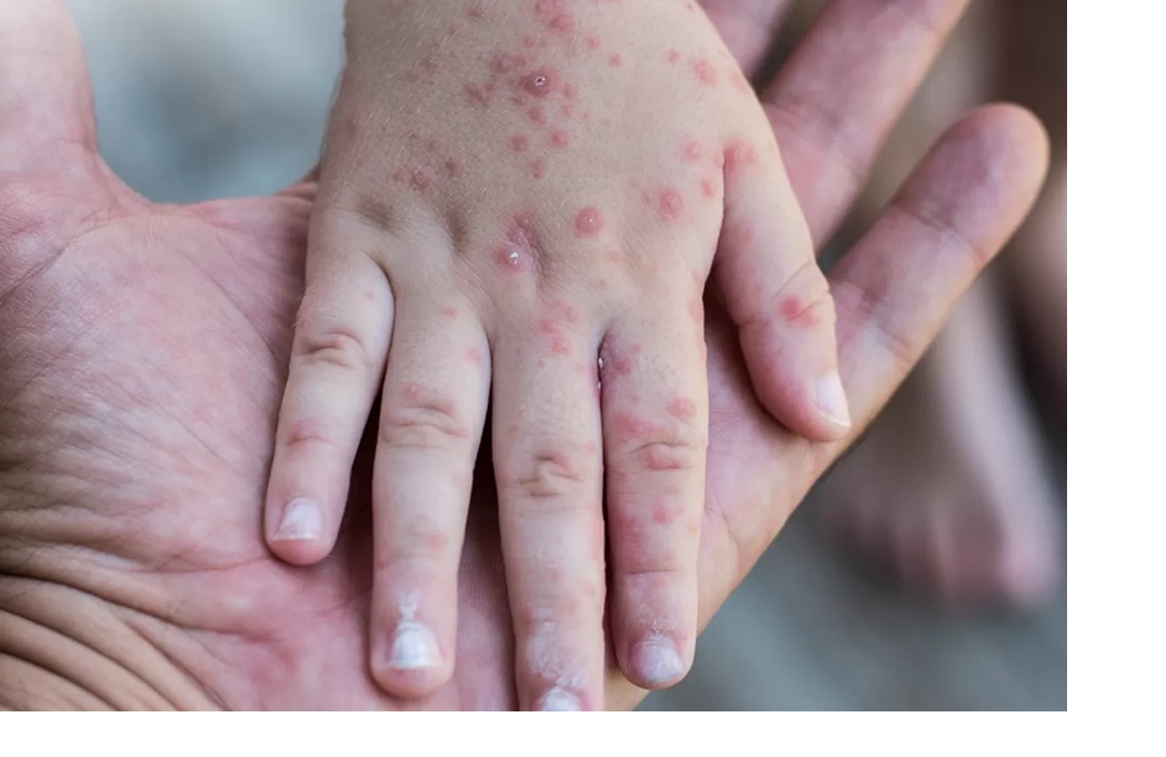 Kenali gejala awal campak dan cara pencegahannya. (PYFA HEALTH)