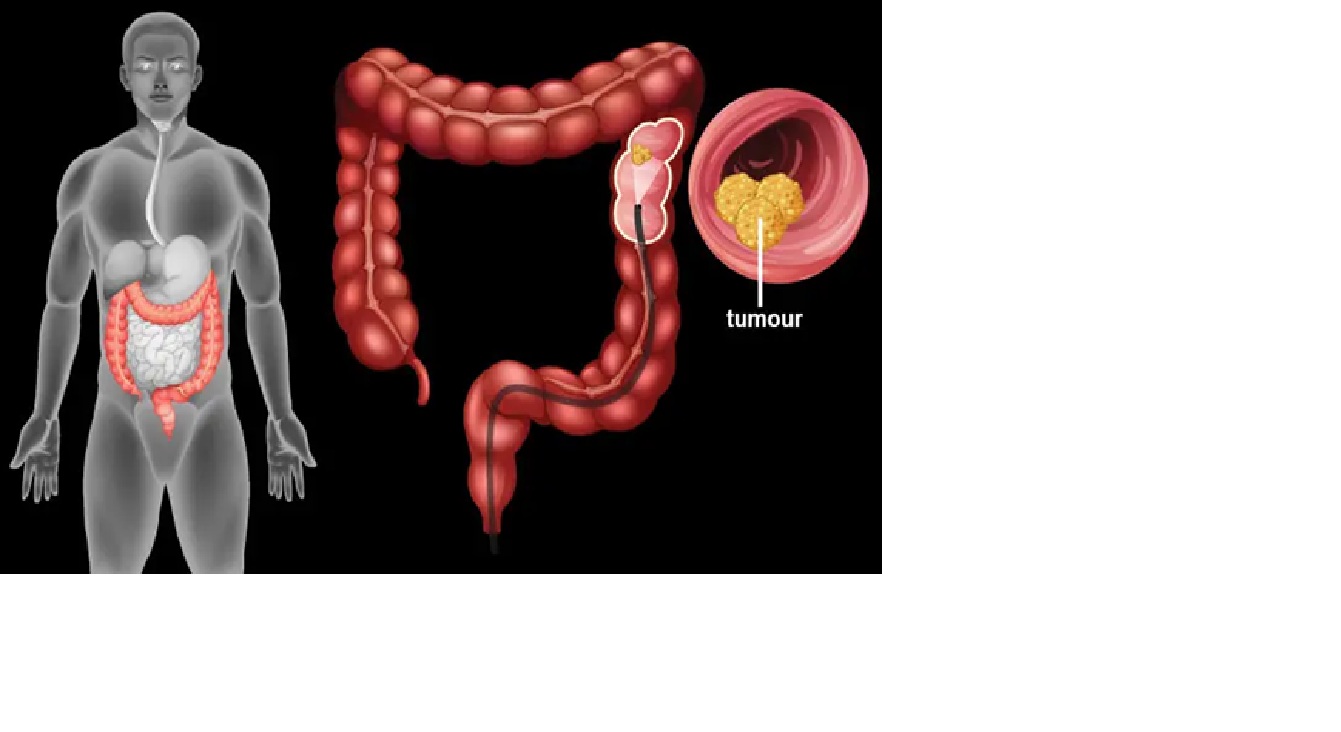 ilustrasi kanker usus besar.