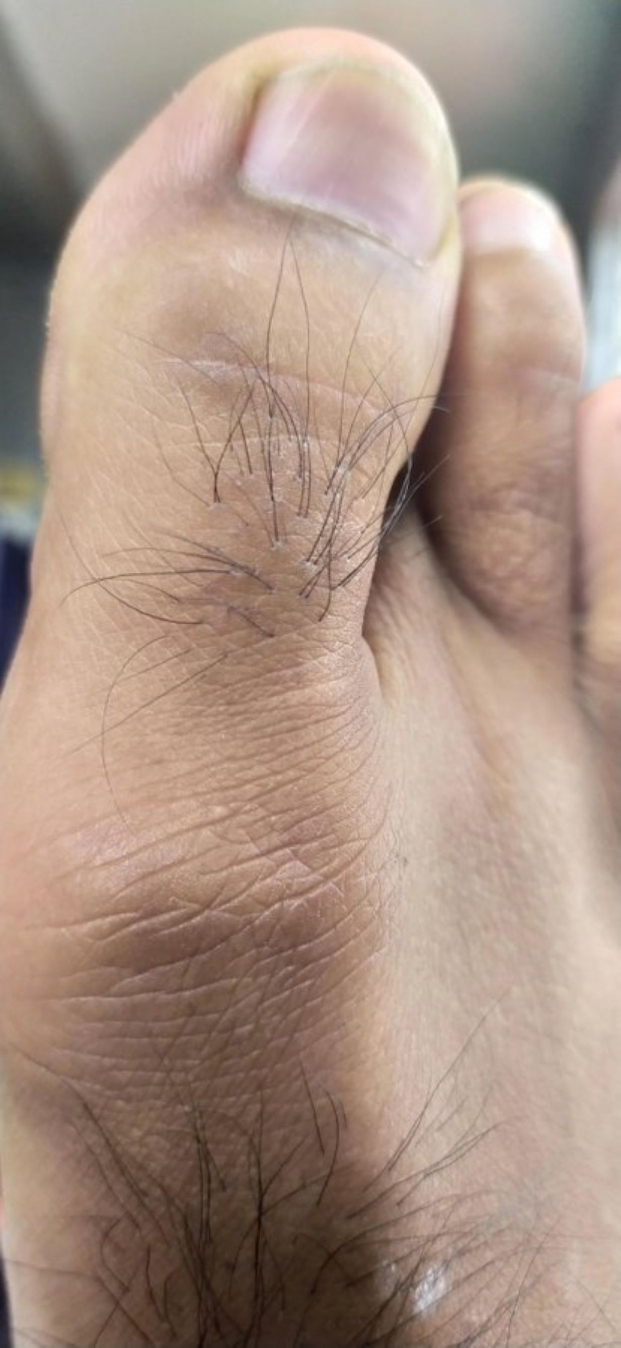 Ilustrasi bulu jempol kaki