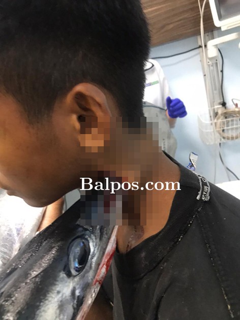 TEMBUS: Idul harus mendapatkan tindakan medis untuk mengeluarkan moncong ikan marlin di lehernya.