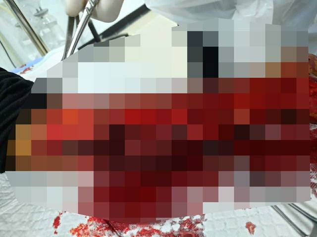 LUKA PARAH: Luka korban pembacokan menggunakan samurai di Tabalong.