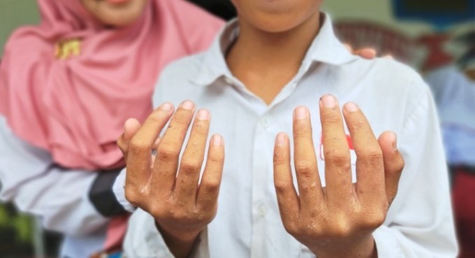 MULAI MENGERING: Didampingi gurunya, siswa SDN Alalak Utara 3 memperlihatkan scabies yang menyasar bagian jari-jari lengannya. FOTO: WAHYU RAMADHAN/RADAR BANJARMASIN