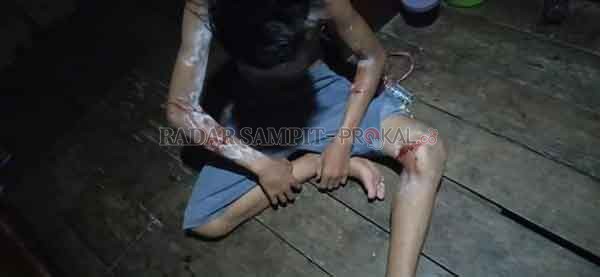 AKIBAT SERANGAN BUAYA: Beberapa bagian tubuh Zakal (14) yang luka akibat serangan buaya di muara sungai Desa Lempuyang, Minggu (25/10) sore.(BKSDA/RADAR SAMPIT)