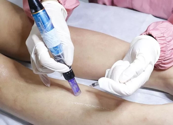 Ilustrasi cara menghilangkan bekas luka.