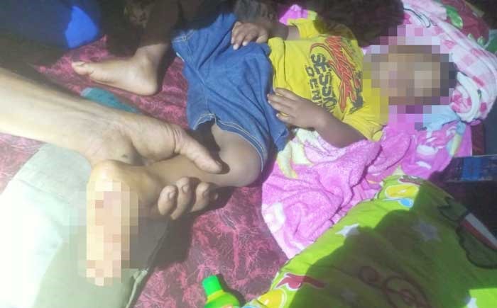 Kaki bocah Iman Saputra berusia 2,1 tahun atau 25 bulan kena cakaran harimau yang masuk ke kamar dan sempat menarik kakinya. Foto diambil Rabu (21/2/2024).