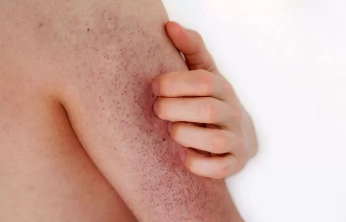 Penyakit Keratosis pilaris