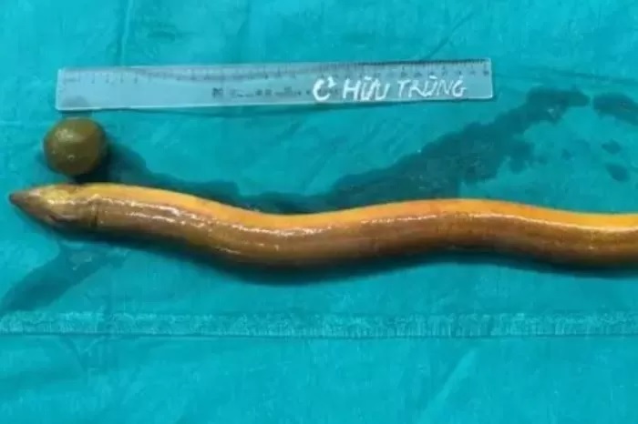Belut masuk ke tubuh seorang pria sepanjang 60 cm.