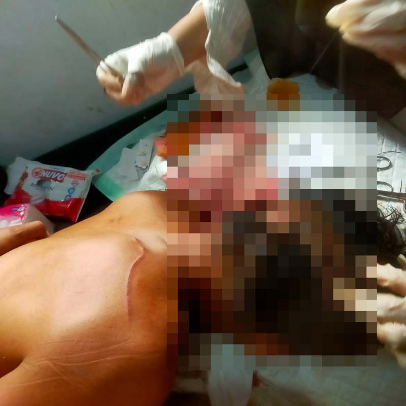Jon Heri saat menjalani perawatan di Pustu Kampung Rawa Mekar Jaya (RMJ), Kecamatan Sungai Apit, Kabupaten Siak, Rabu (4/9/2024).