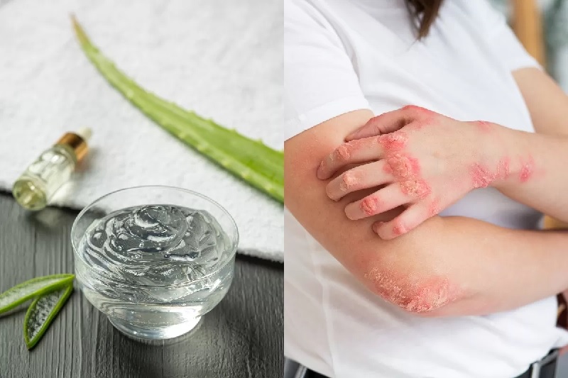 Aloe Vera untuk eksim.