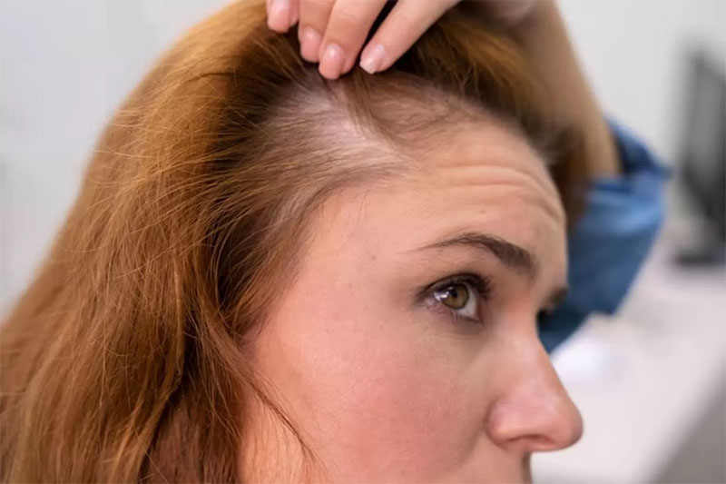 ilustrasi rambut menipis pada seorang perempuan.