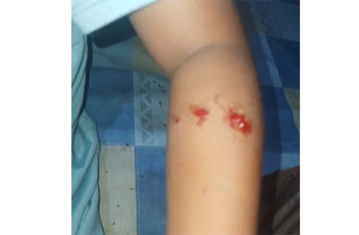 Luka tangan bagian kiri Bunga Mafasya Azhara, bocah Lubuk Ambacang Kecamatan Hulu Kuantan yang digigit buaya, Kamis (6/11/2025) sore.