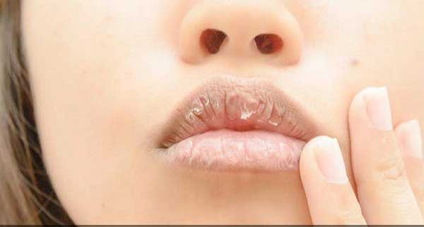 Bibir pecah (foto/jpnn.com)