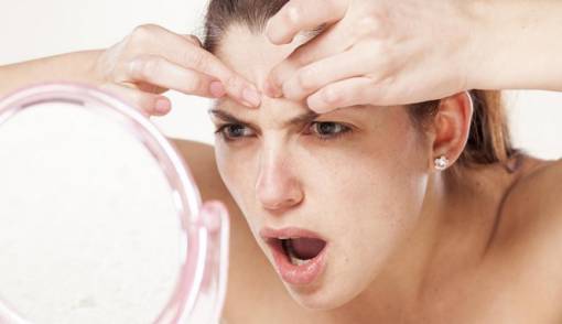 Ilustrasi: Muka berjerawat (jpnn.com)