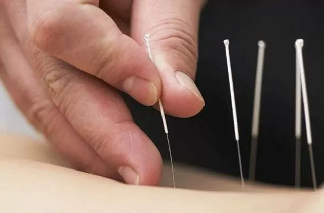 Akupuntur adalah pengobatan tradisional Tiongkok.