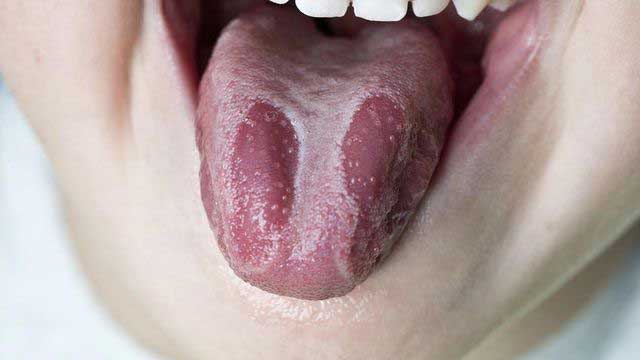 Jamur pada lidah (foto/jpg)