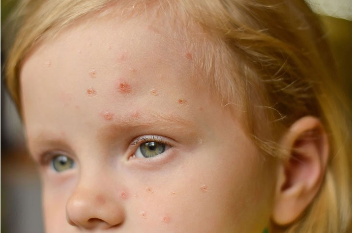 Ilustrasi ruam di wajah. Ruam pada campak memiliki ciri khas tersendiri.