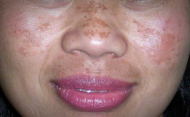 wajah flek hitam(int)