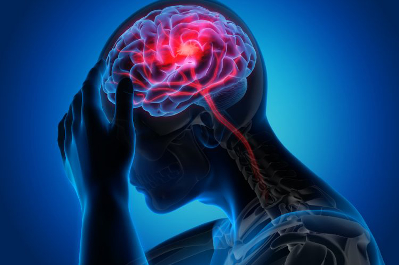 Ilustrasi stroke. Stroke adalah ketika aliran darah ke otak terputus, menyebabkan sel-sel otak mati karena kekurangan oksigen.